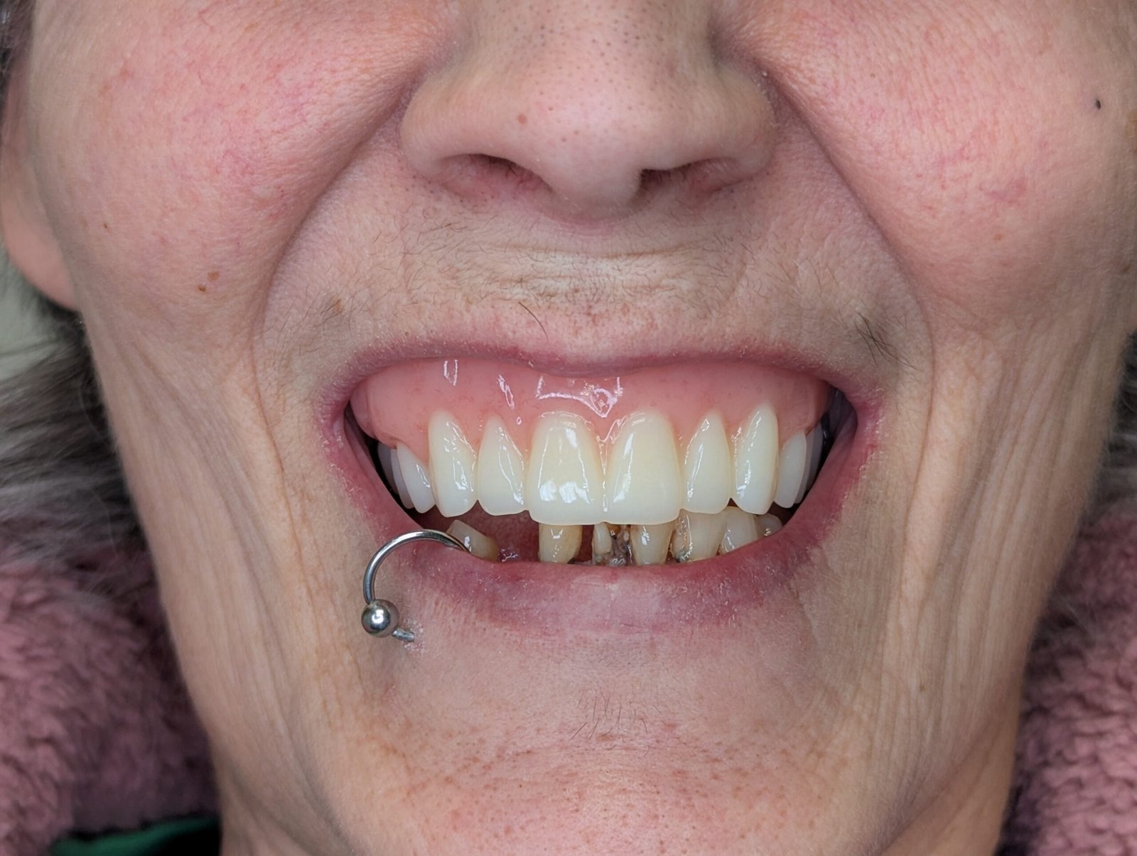 After Denture 1