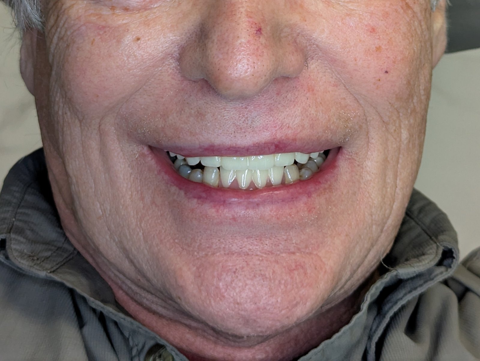 After Denture 3