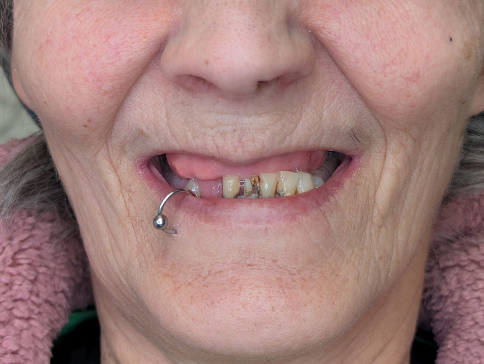 Before Denture 1