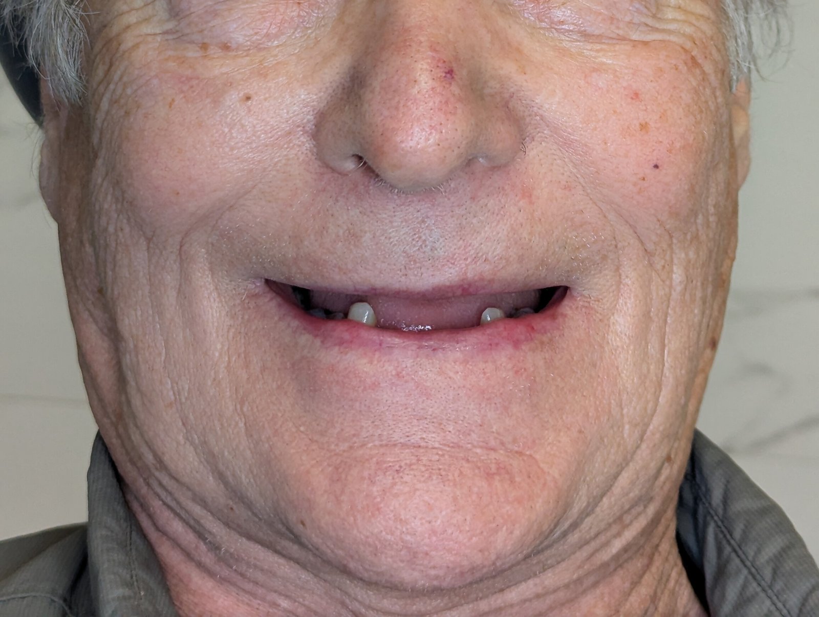 Before Denture 3